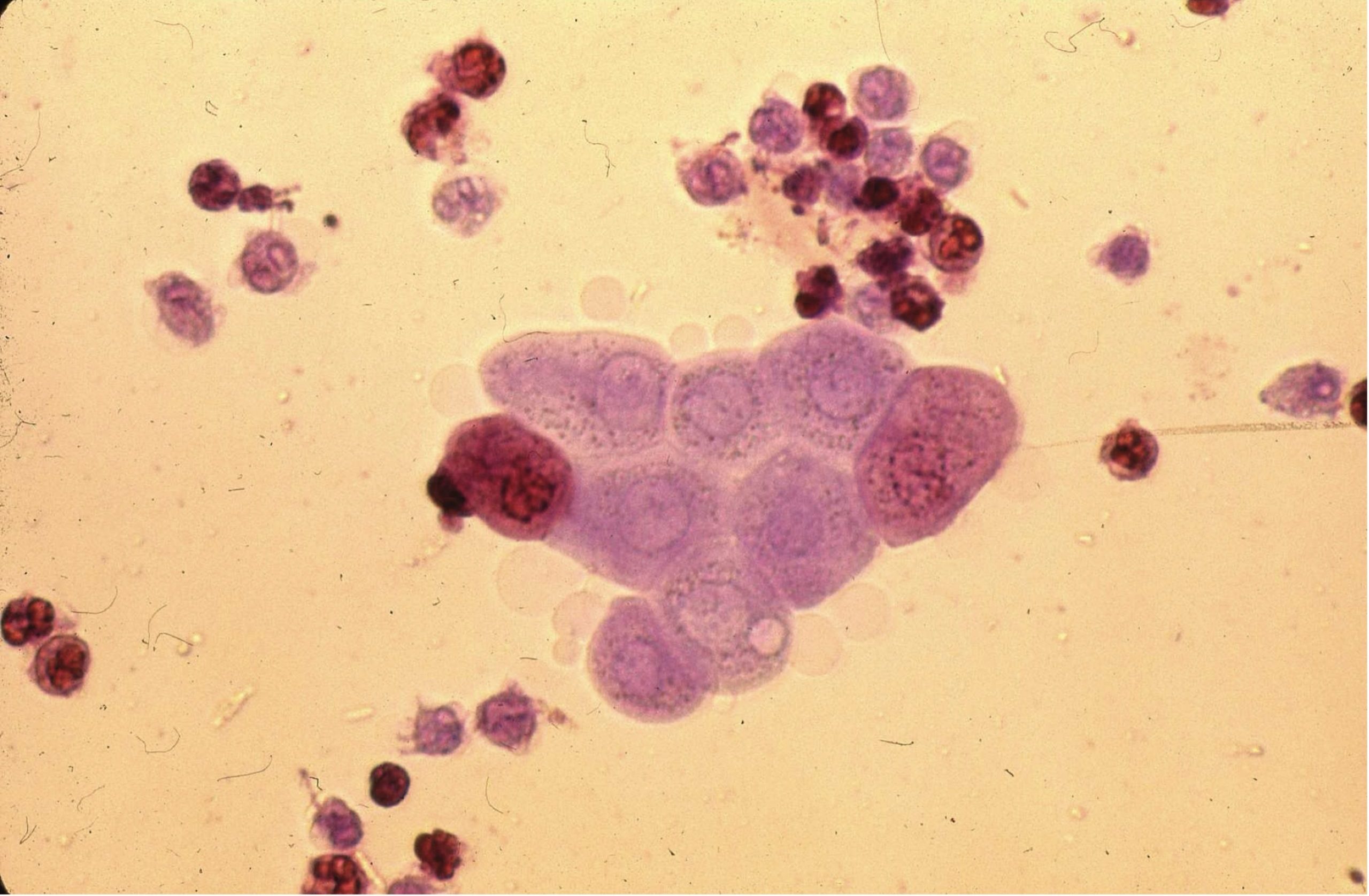 Figure 7.6 Urine sediment, sedistain. Cluster of transitional epithelial cells with leukocytes.