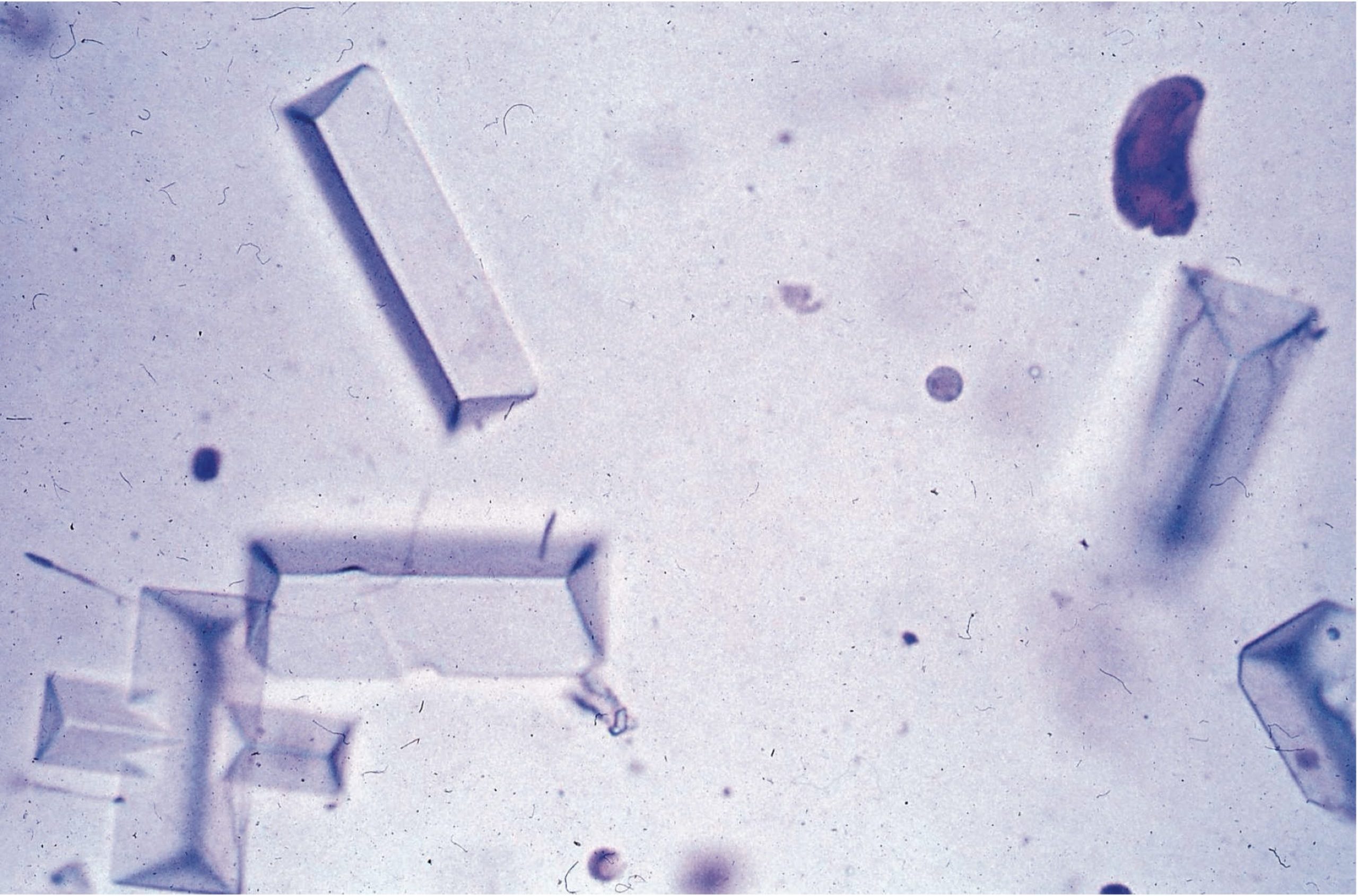 Figure 7.7 Urine sediment, sedistain. Struvite crystals.