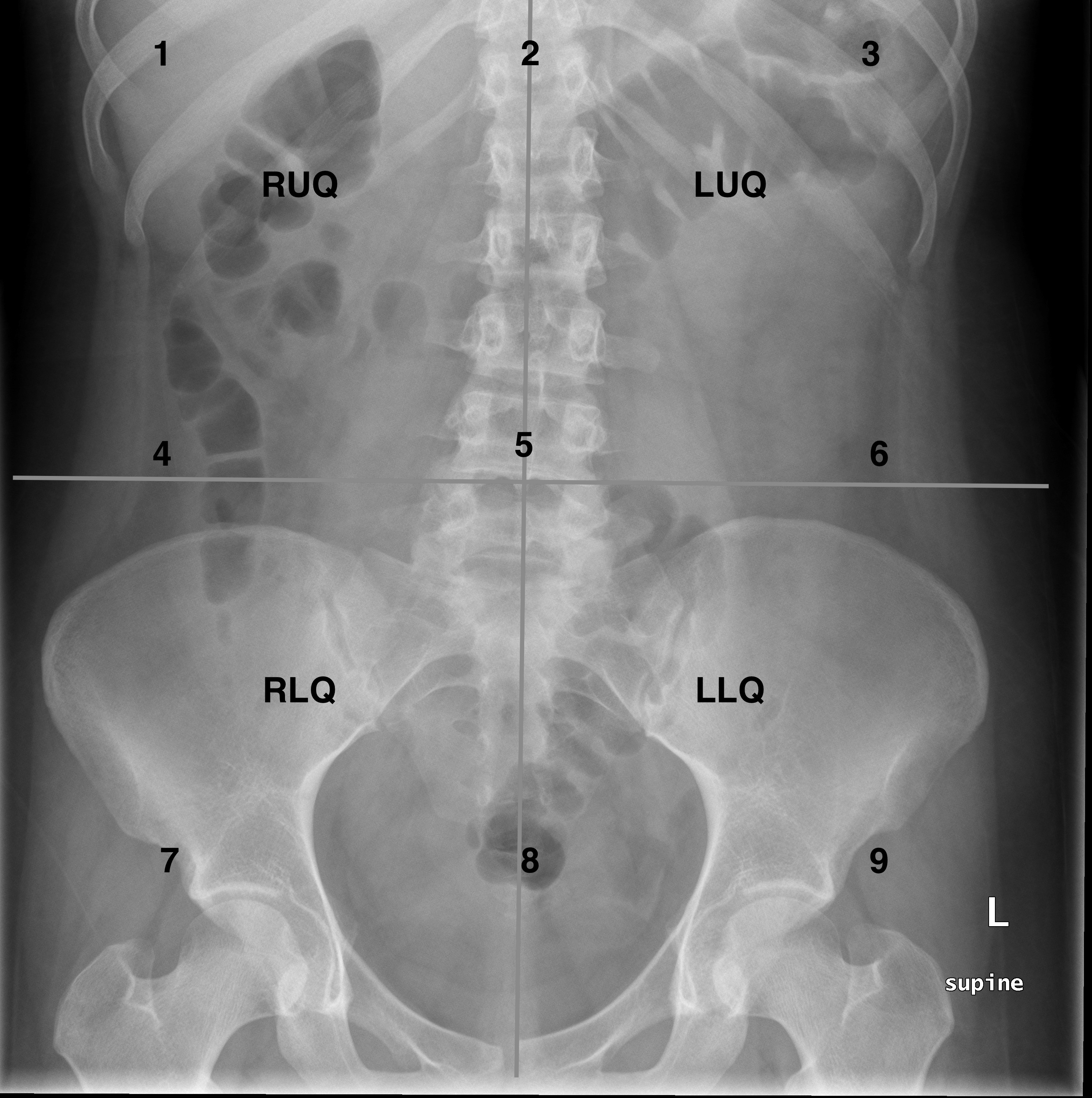 abdominal x ray presentation