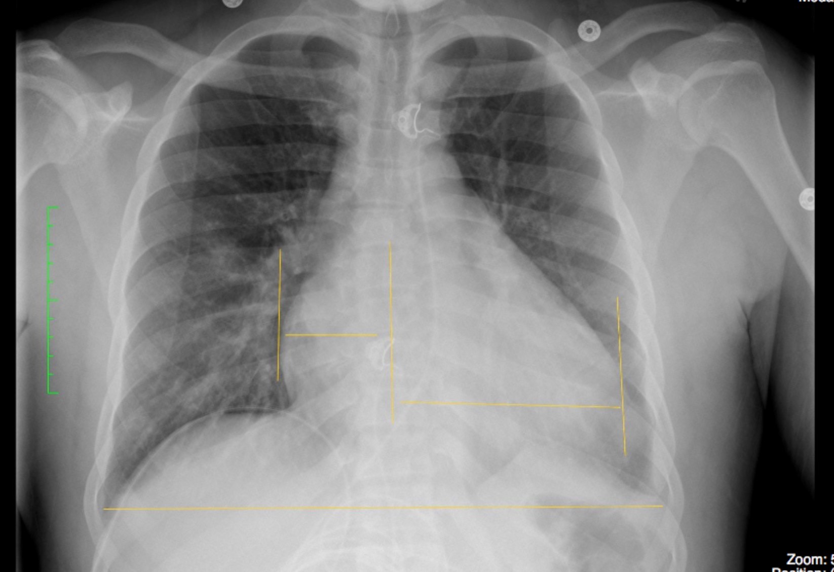 Enlarged Heart X Ray