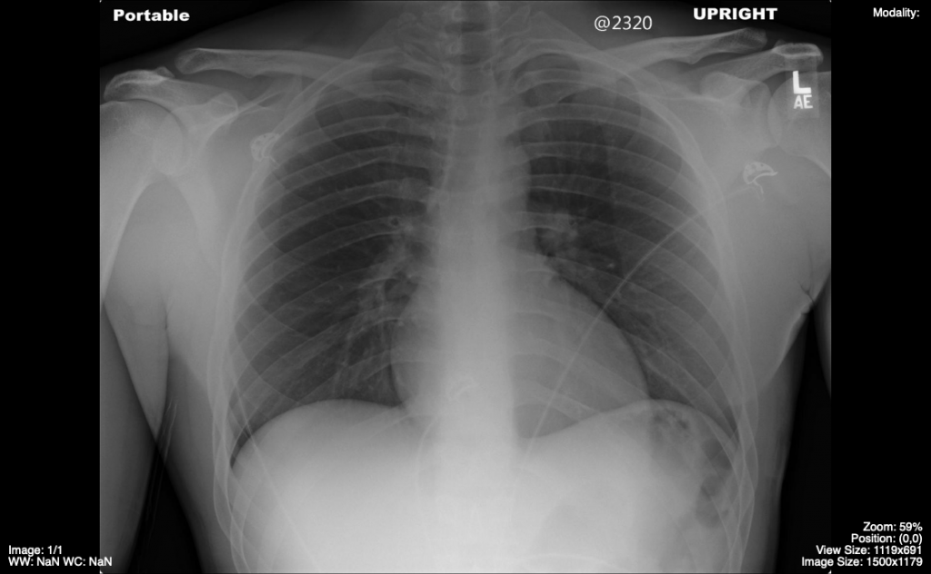 Approach To The Chest X Ray Cxr Undergraduate Diagnostic Imaging Fundamentals
