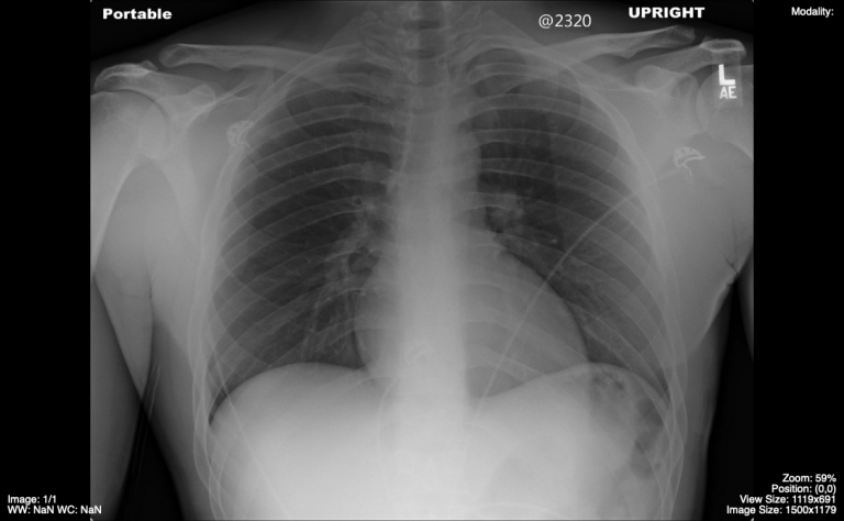 Approach To The Chest X Ray Cxr Undergraduate Diagnostic Imaging