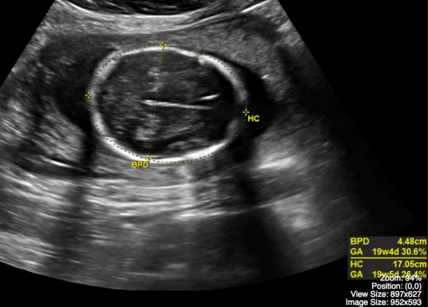 Fetal Head Ultrasound Measurements | Hot Sex Picture