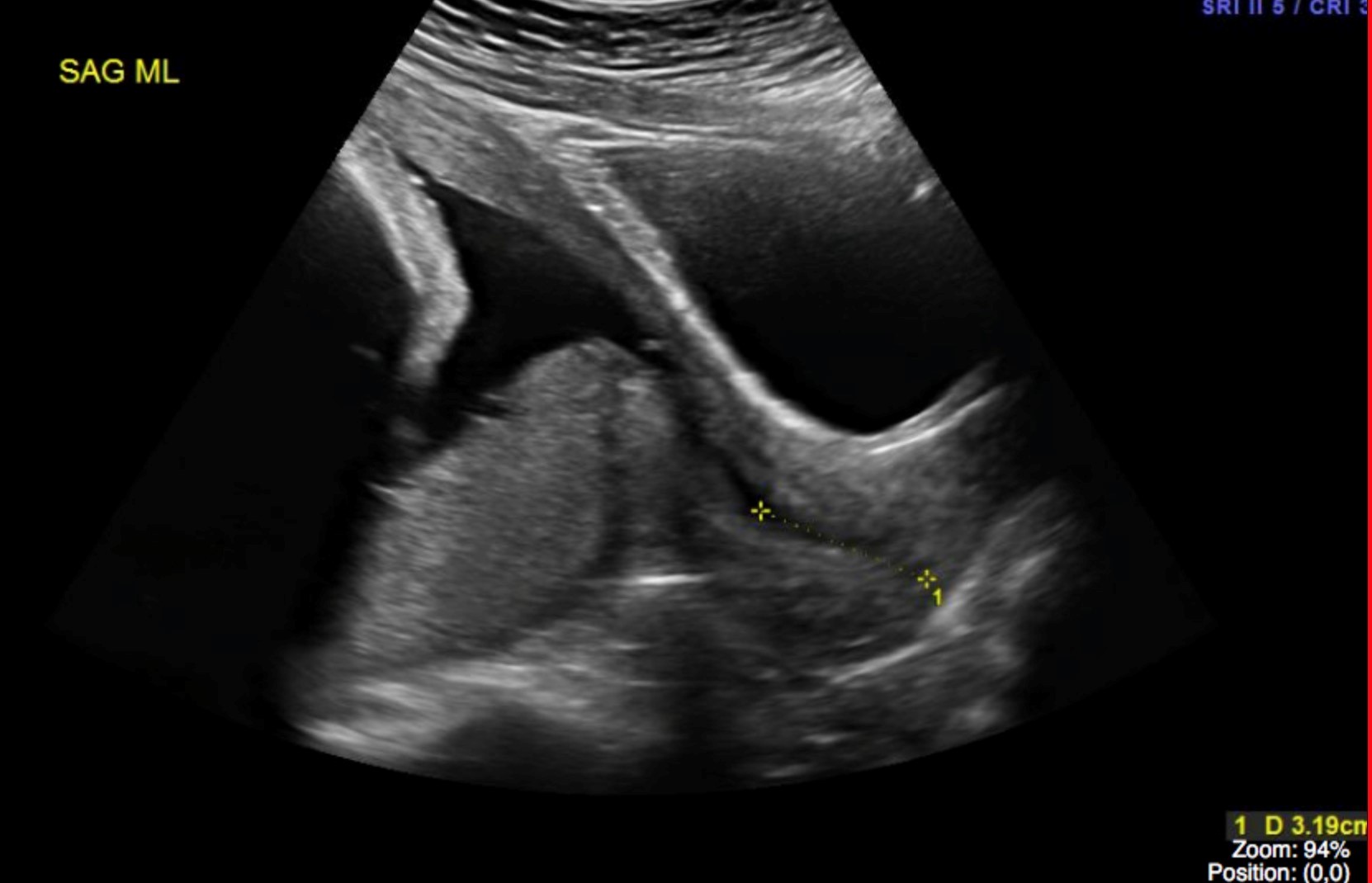 Posterior Placenta Ultrasound