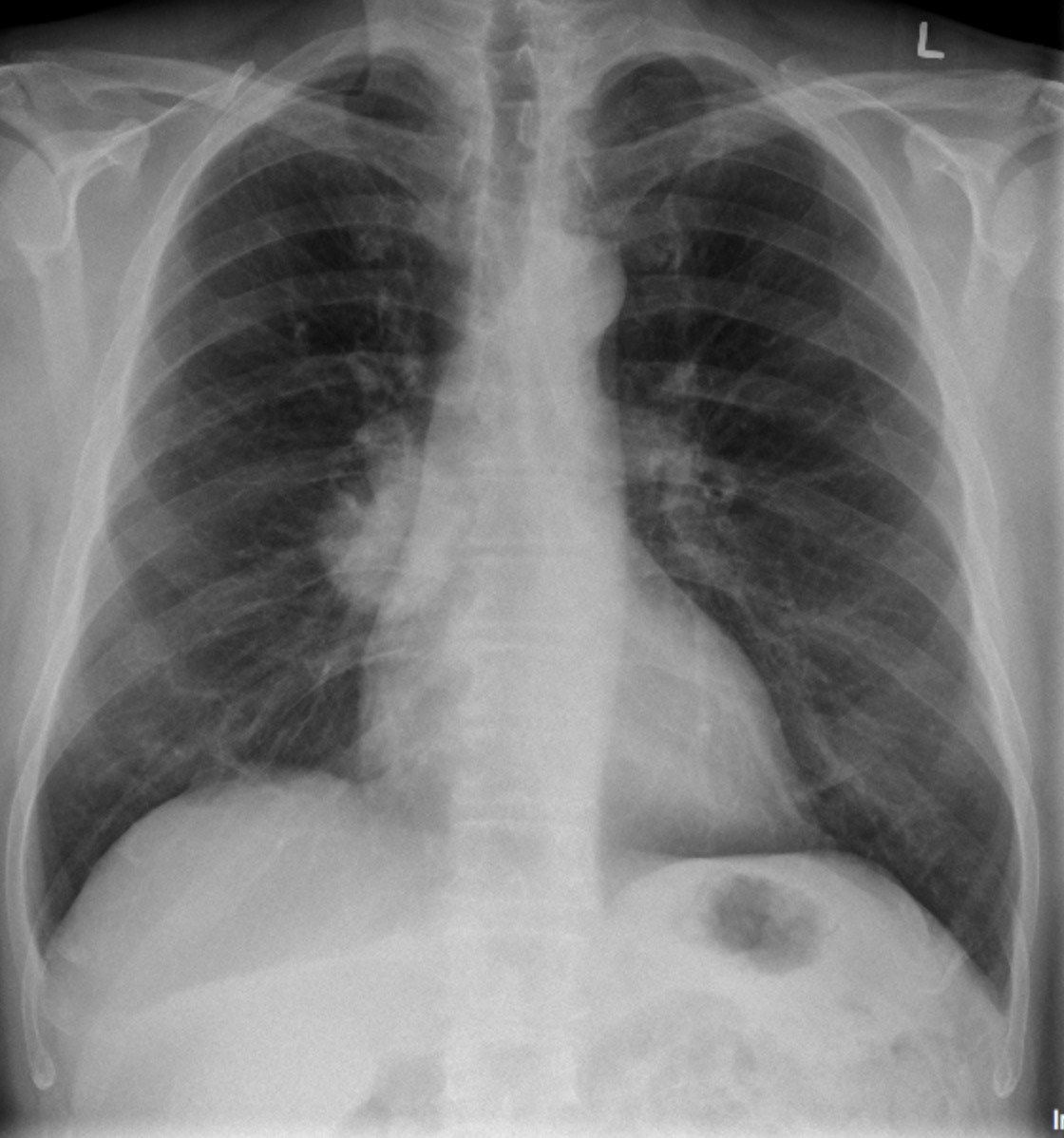 Solitary Lung Nodule Undergraduate Diagnostic Imaging Fundamentals