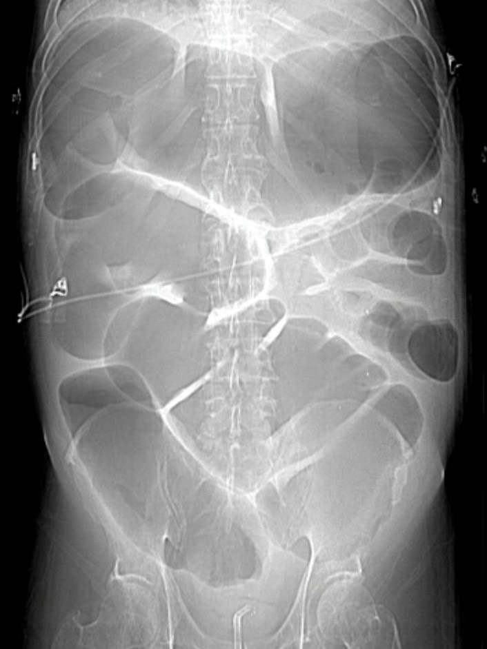 Toxic Megacolon Radiology