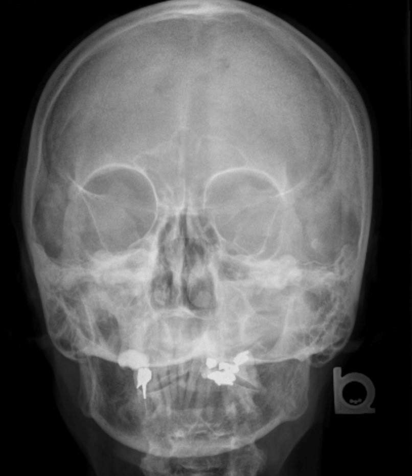 Sinusitis X Ray Sinus Maxillary Karnusherbal 3 