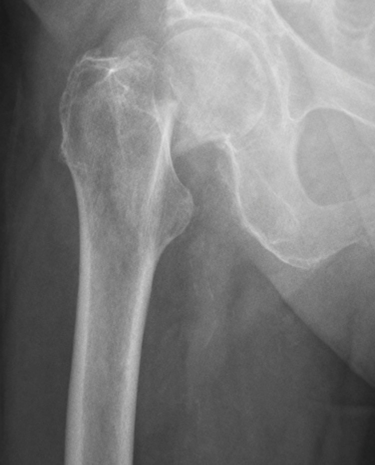 nondisplaced subcapital femoral neck fracture