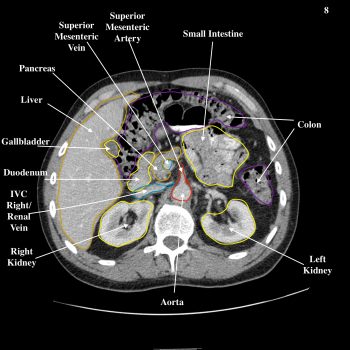 Abdomen – Undergraduate Diagnostic Imaging Fundamentals