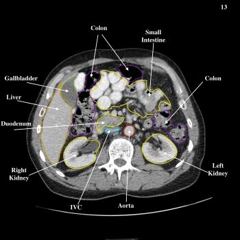 Abdomen – Undergraduate Diagnostic Imaging Fundamentals