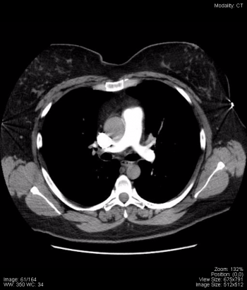 Chest – Undergraduate Diagnostic Imaging Fundamentals