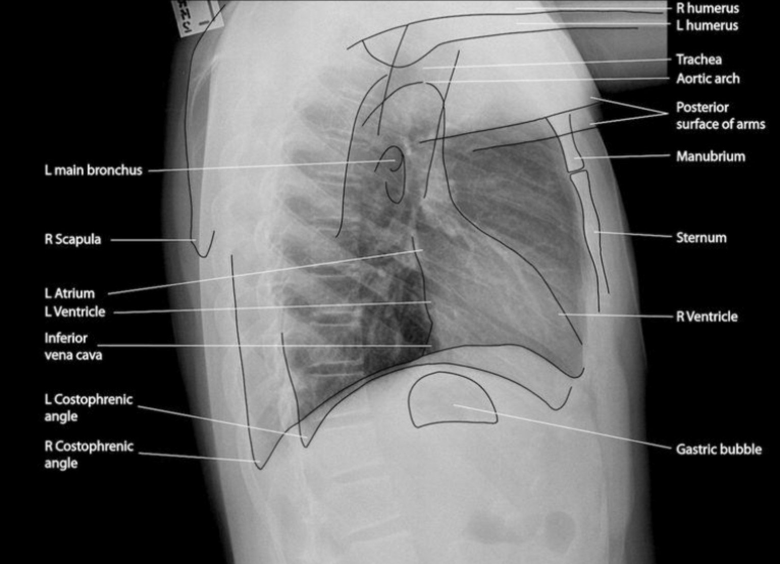 Anatomy Of Chest X Ray Lateral Chest Radiograph Anatomy Normal Cloobx