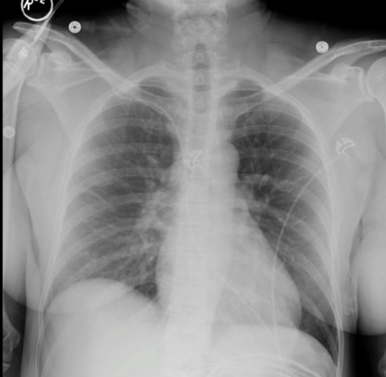 Tubes and Catheters – Undergraduate Diagnostic Imaging Fundamentals