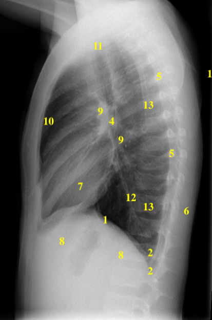 A) Chest x-ray of the propositus: cone-shaped chest, clavicular