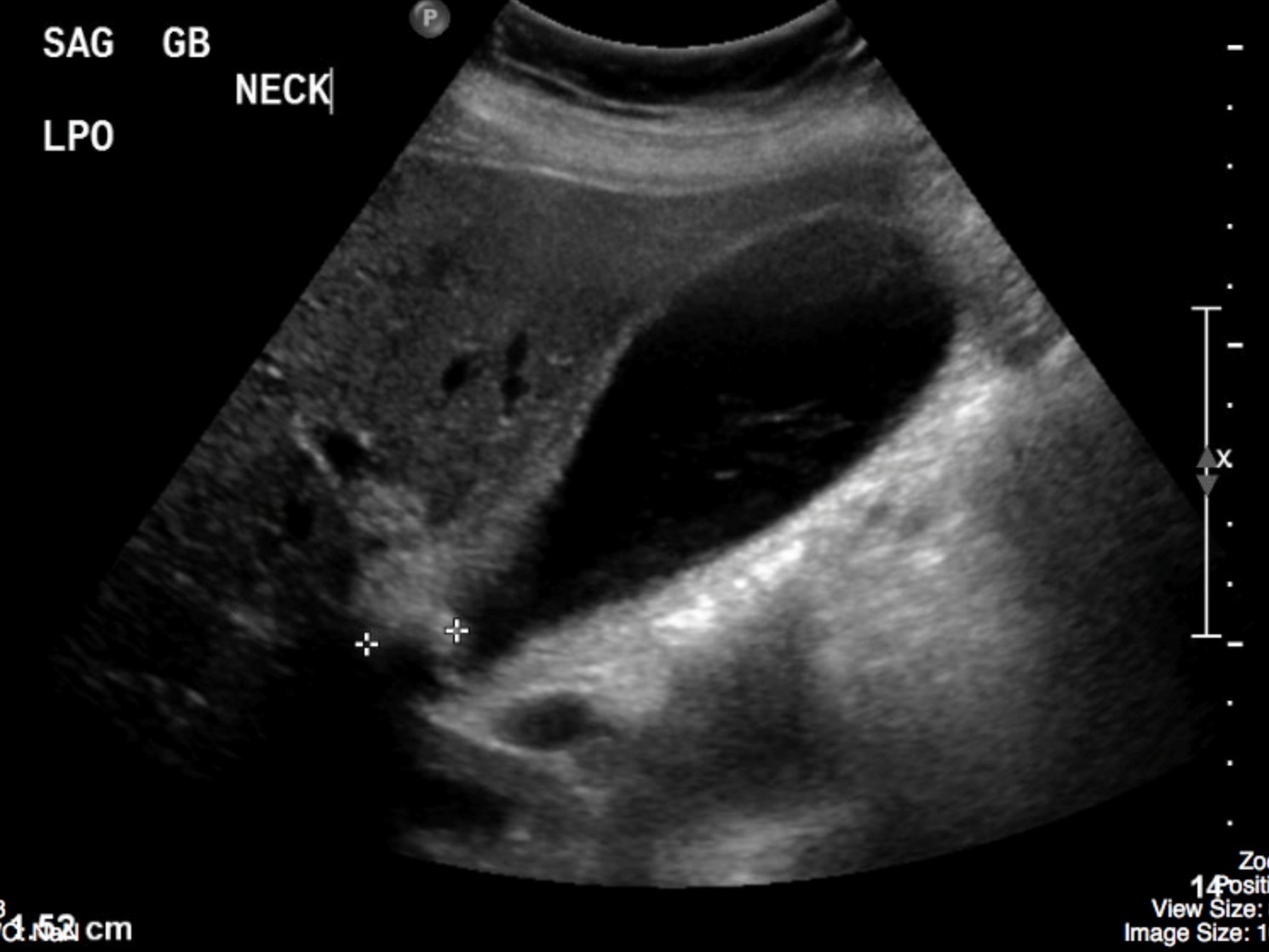 Gallbladder Abscess Ultrasound Sexiz Pix