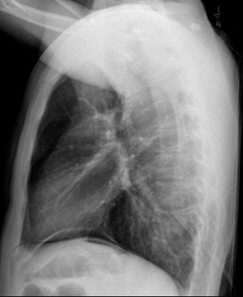 Intestinal Perforation- Pneumoperitoneum – Undergraduate Diagnostic ...