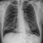 Intestinal Perforation- Pneumoperitoneum – Undergraduate Diagnostic ...