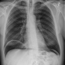 Intestinal Perforation- Pneumoperitoneum – Undergraduate Diagnostic 