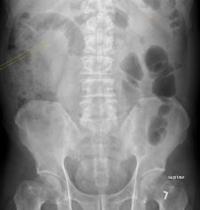 Ileus – Undergraduate Diagnostic Imaging Fundamentals