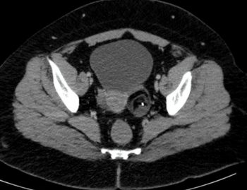 Benign and Malignant Tumours of the Female Reproductive System ...