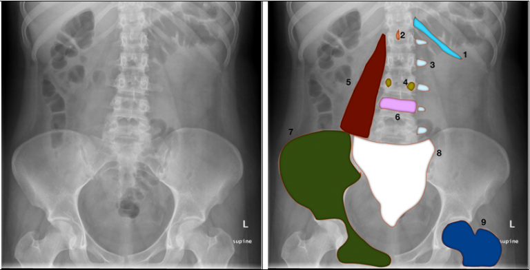 Approach To The Abdominal X Ray Axr Undergraduate Diagnostic Imaging Fundamentals