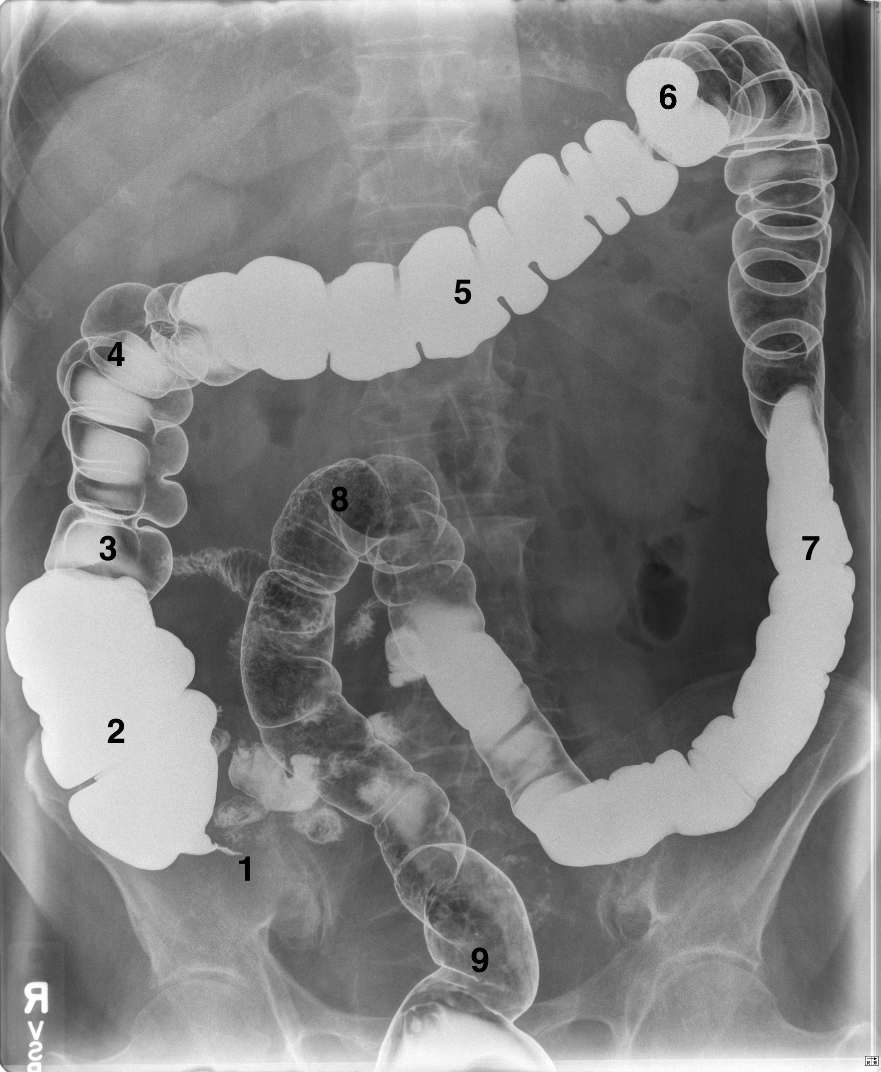 Approach To The Abdominal X-ray (axr) – Undergraduate Diagnostic 