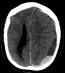 Intracranial Hemorrhage – Traumatic – Undergraduate Diagnostic Imaging ...