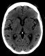 Ischemic Stroke – Undergraduate Diagnostic Imaging Fundamentals