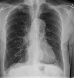 Emphysema – Undergraduate Diagnostic Imaging Fundamentals