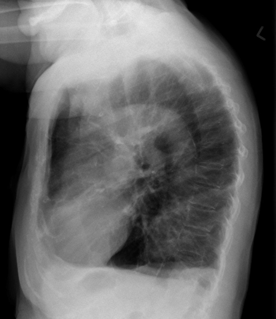 Emphysema – Undergraduate Diagnostic Imaging Fundamentals