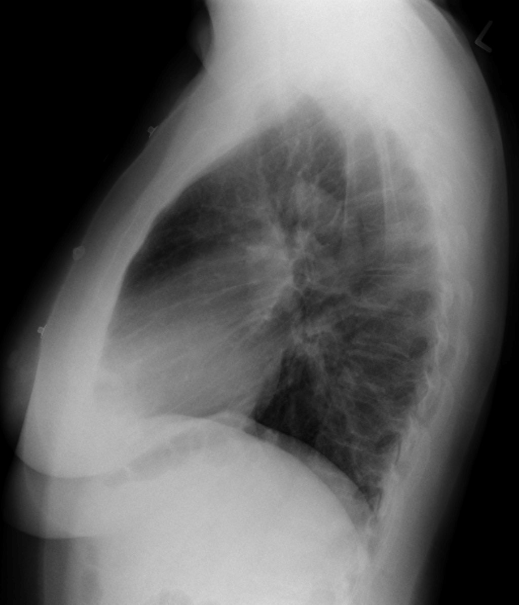 Pulmonary Thromboembolism – Undergraduate Diagnostic Imaging Fundamentals