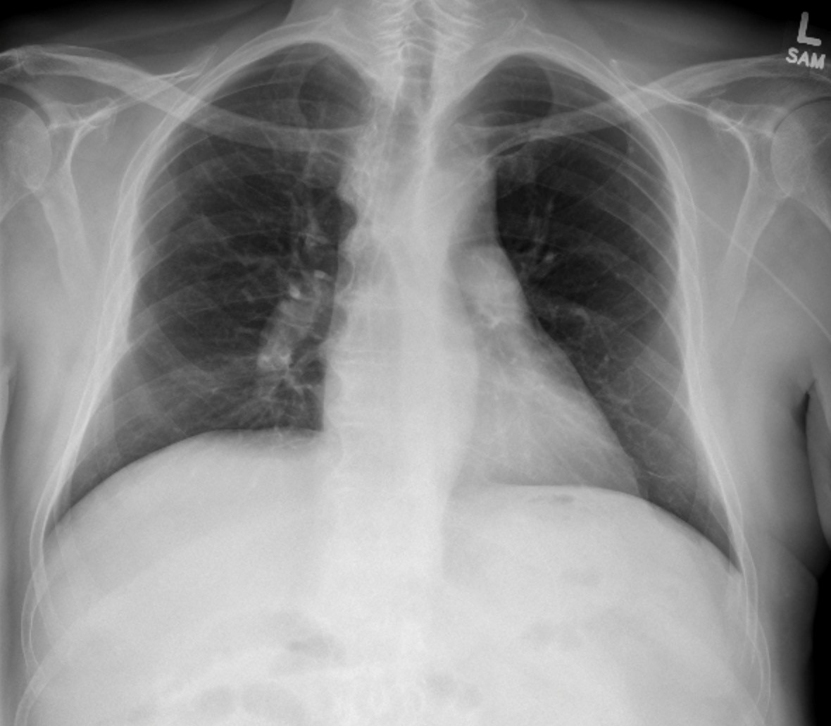 Pulmonary Thromboembolism – Undergraduate Diagnostic Imaging Fundamentals