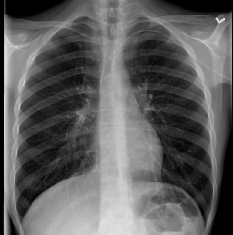 Tubes and Catheters – Undergraduate Diagnostic Imaging Fundamentals