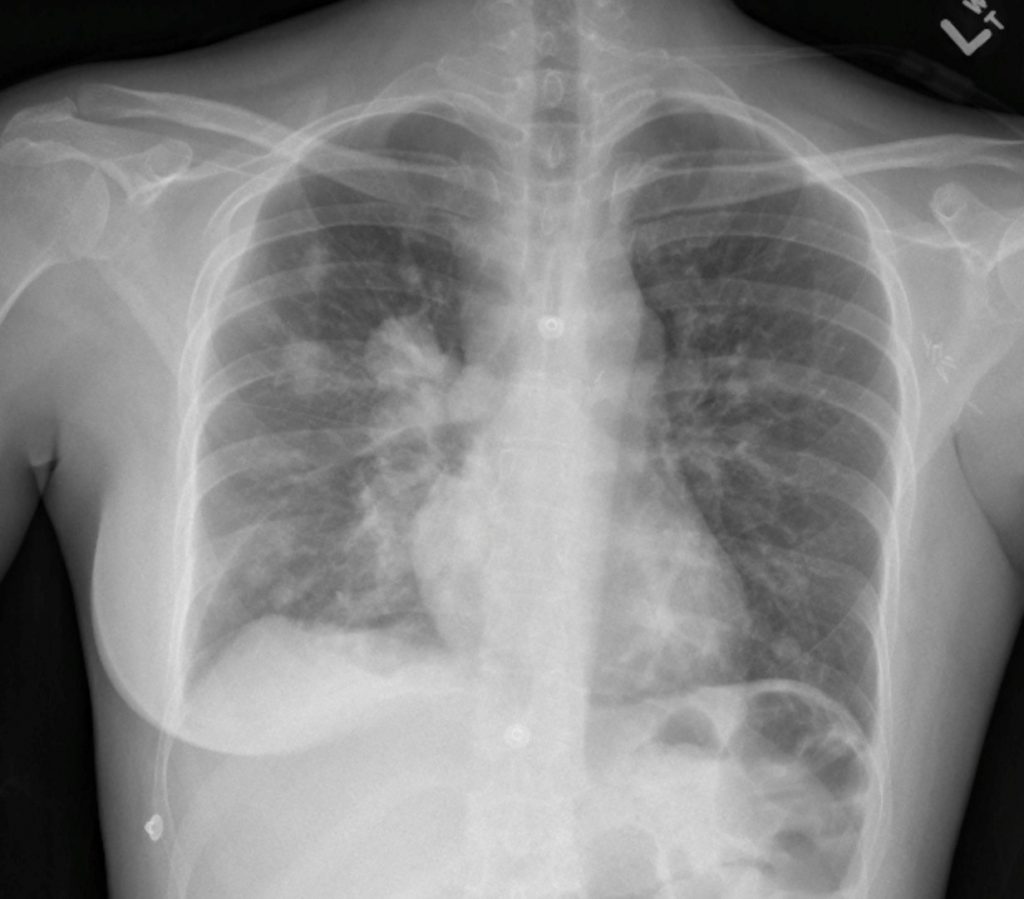 Right Pleural Effusion Ultrasound