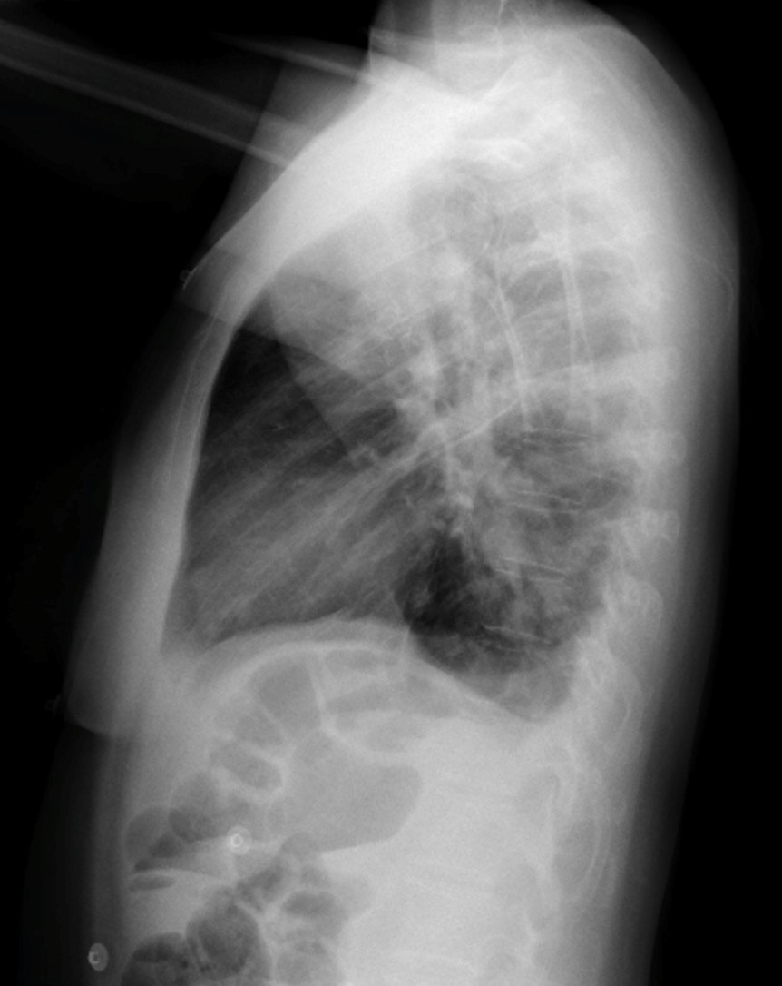 Pleural Effusion – Undergraduate Diagnostic Imaging Fundamentals