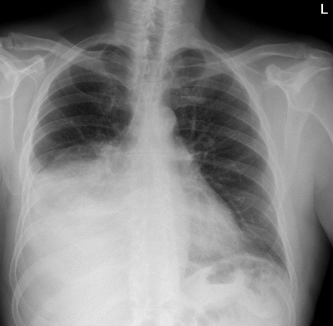 Pleural Effusion – Undergraduate Diagnostic Imaging Fundamentals