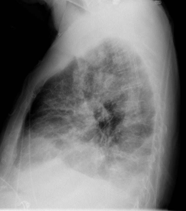 Pneumonia – Undergraduate Diagnostic Imaging Fundamentals