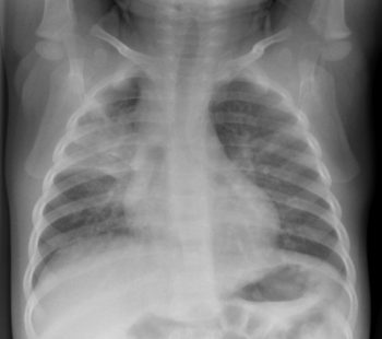 Pneumonia – Undergraduate Diagnostic Imaging Fundamentals