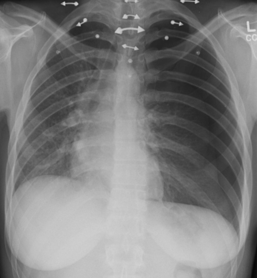 File:Figure 9.21A AP Chest x-ray, Pneumothorax, Tension.jpg - NC Commons