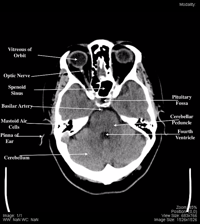 Anatomy Of Brain Ct Scan Anatomy Drawing Diagram Imag - vrogue.co