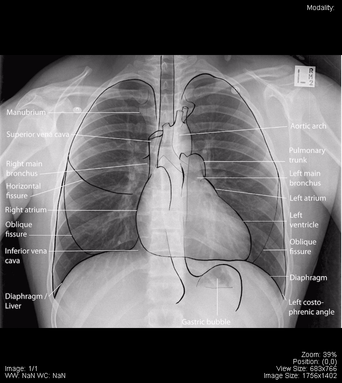 Anatomy Of Chest X Ray Normal Chest X Ray Radiology Case
