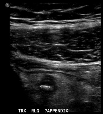 Appendicitis – Undergraduate Diagnostic Imaging Fundamentals