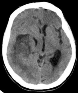 Tumours of the Brain – Undergraduate Diagnostic Imaging Fundamentals