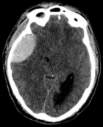 Intracranial Hemorrhage – Traumatic – Undergraduate Diagnostic Imaging ...