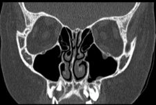 Facial Trauma – Undergraduate Diagnostic Imaging Fundamentals