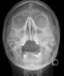 Sinusitis/Mastoiditis – Undergraduate Diagnostic Imaging Fundamentals