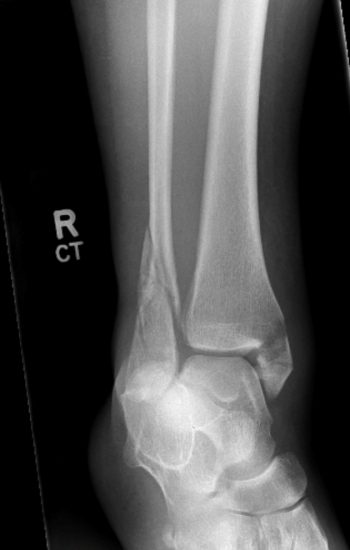 Ankle Trauma Fractures Undergraduate Diagnostic Imaging Fundamentals