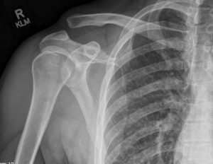 Acromioclavicular Joint Separation – Undergraduate Diagnostic Imaging ...