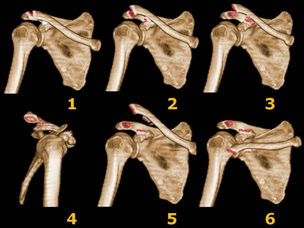 Acromioclavicular Joint X Ray