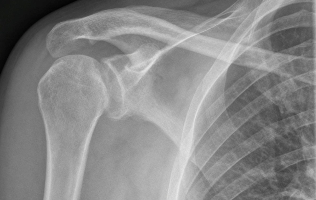 Glenohumeral Dislocation – Anterior And Posterior – Undergraduate ...